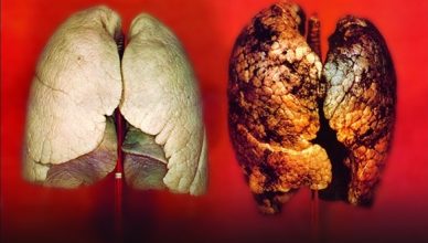 akciğer kanseri hakkında bilgi